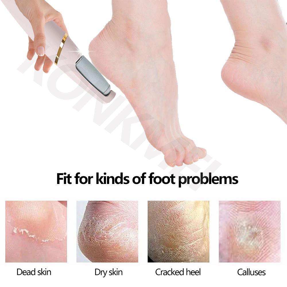 Electric Heel Callus Remover/ Foot File Care Tool/ Feet Hard Dead Skin  Removal Pedicure Device Usb Recharging Style - Foot Care Tool - AliExpress